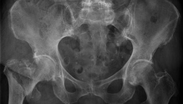 X-ray of a right hip fracture
